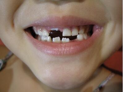 杭州牙齿缺了一块要怎么治疗